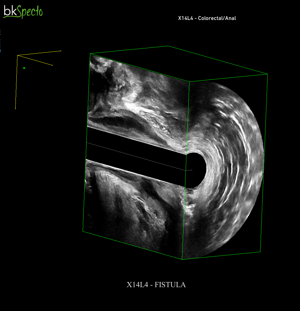 why-use-3d-ultrasound-imaging-to-prepare-for-anal-fistula-surgery